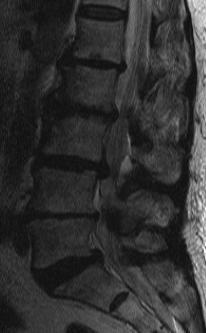 Lumbar Stenosis MRI